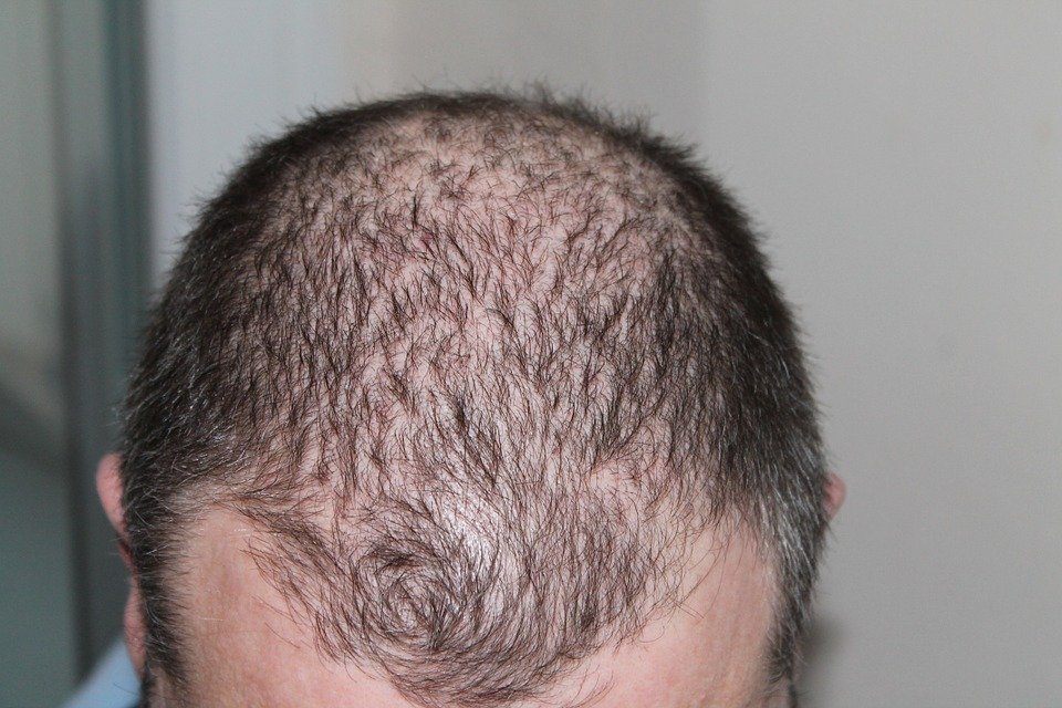 hair transplant